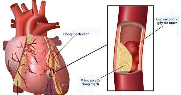 Biến chứng tim mạch của bệnh tiểu đường