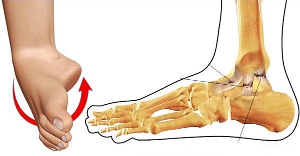 Điều trị phẫu thuật gãy bàn chân