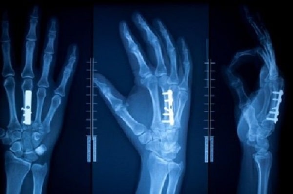 Điều trị gãy xương bàn tay không phẫu thuật