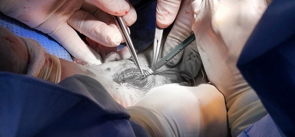 Điều trị gãy xương mắt cá chân phẫu thuật