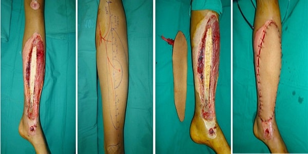 Điều trị phẫu thuật gãy xương cẳng chân
