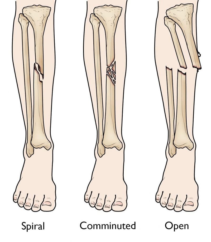 Gãy xương cẳng chân: Triệu chứng chẩn đoán & Cách điều trị