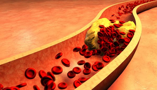 Cholesterol máu cao nên ăn gì? 