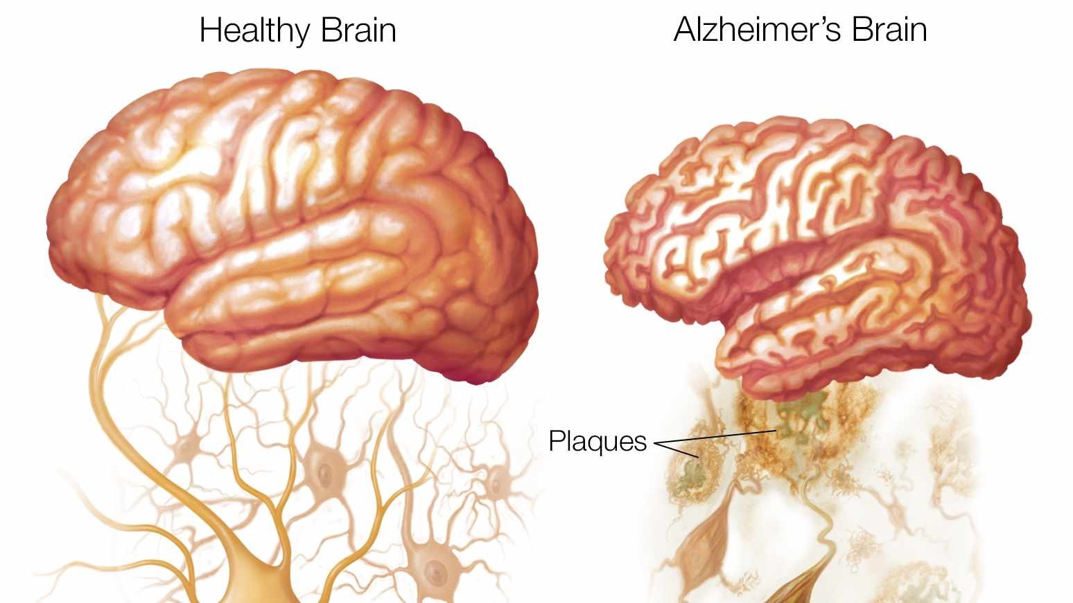 Kết quả hình ảnh cho Alzheimer